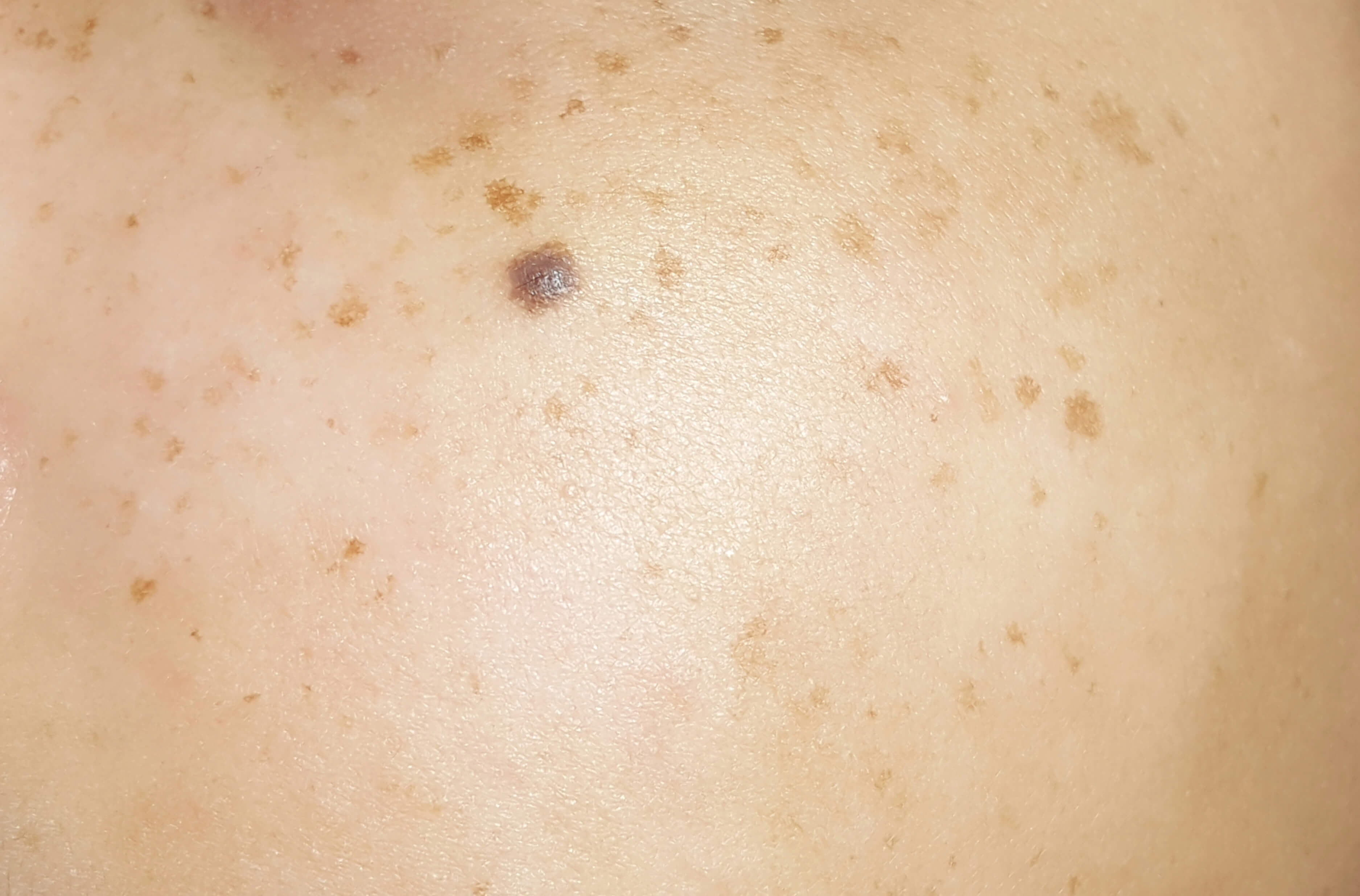 Dark Spot Removal in Greensboro, North Carolina
