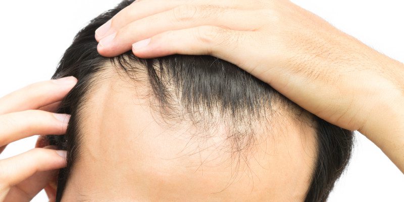 Hair Growth in Winston-Salem, North Carolina