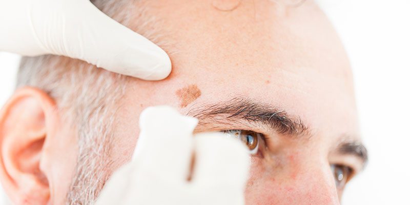 Restore Your Skin’s Beauty and Your Confidence with Sunspot Removal