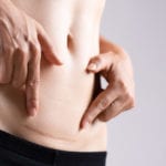 Scar Removal in Winston-Salem, North Carolina