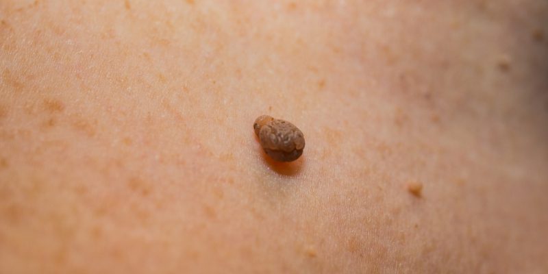 skin tag removal is still a medical procedure
