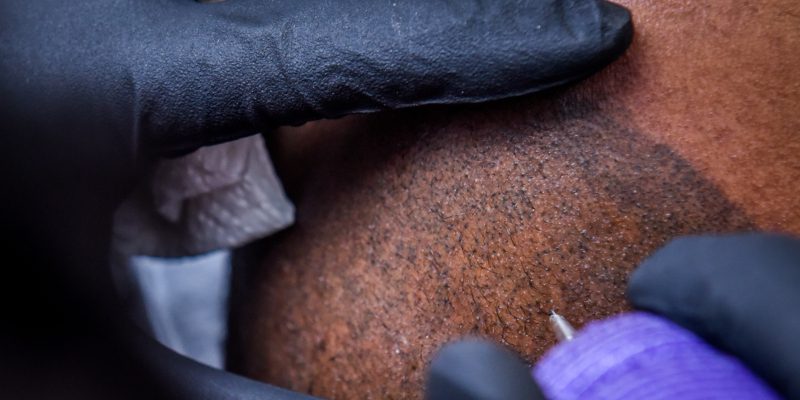 scalp micropigmentation is a tattooing process
