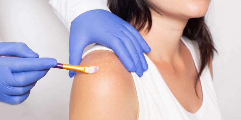 Sun Spot Removal in Winston-Salem, North Carolina