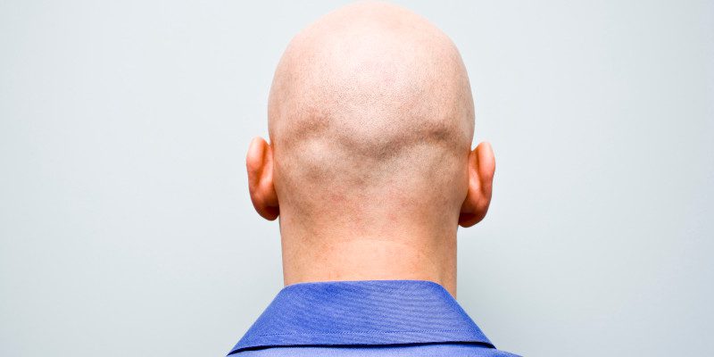 Balding in Winston-Salem, North Carolina