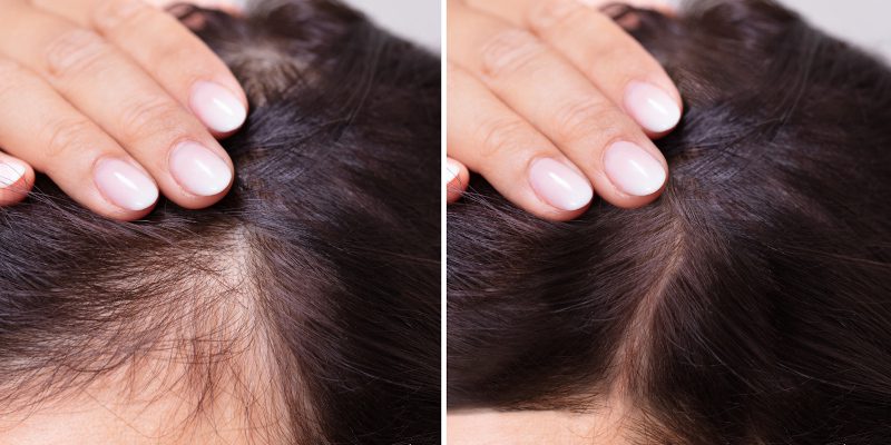 Receding Hairline in Winston-Salem, North Carolina