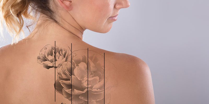 Do You Want to Remove That Tattoo? Reasons to Consider Our Removal Process