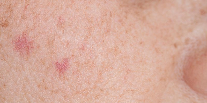 Sun Spot Removal Can Renew Your Confidence