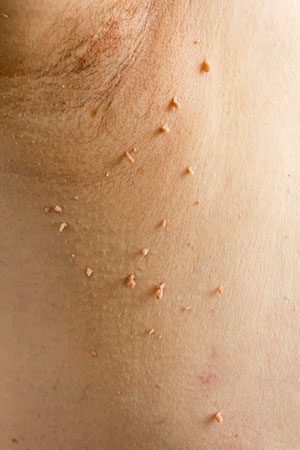 Why Skin Tag Removal Is Worthwhile