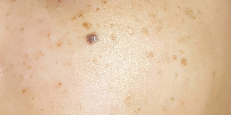Dark Spot Removal in Asheboro, North Carolina