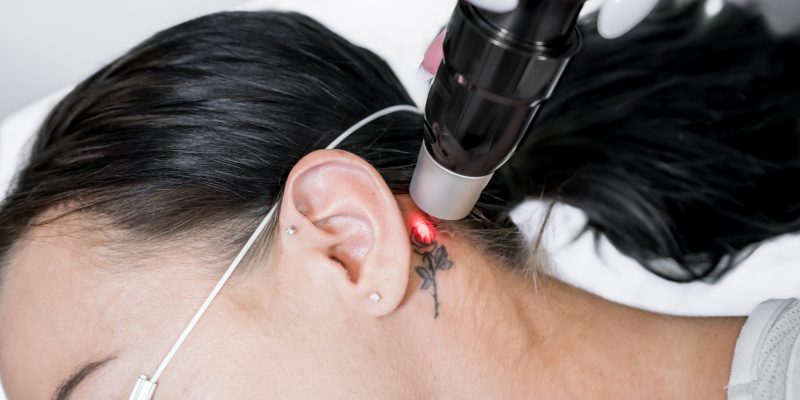 How to Tell if You’re Ready for a Tattoo Removal