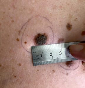 Reasons to Use Our Mole Removal Services