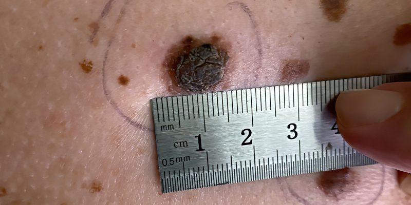 Reasons to Use Our Mole Removal Services