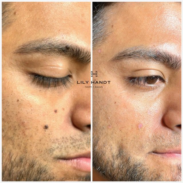 Mole Removal