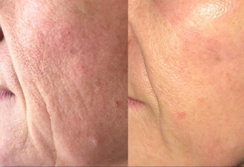 Non-Surgical Skin Lift in Winston-Salem, North Carolina