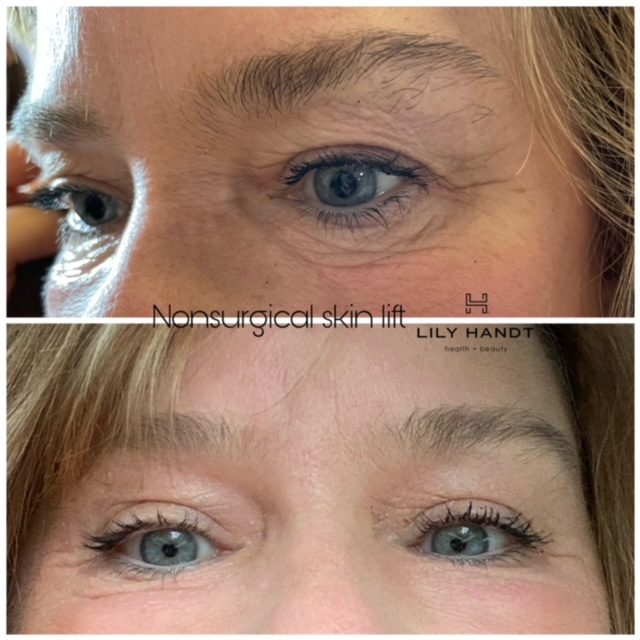 Non-Surgical Skin Lift in Winston-Salem, North Carolina