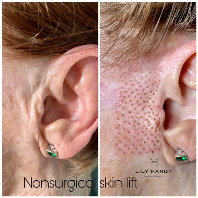 Non-Surgical Skin Lift in Winston-Salem, North Carolina
