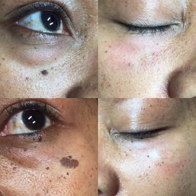 Spot Removal in Winston-Salem, North Carolina