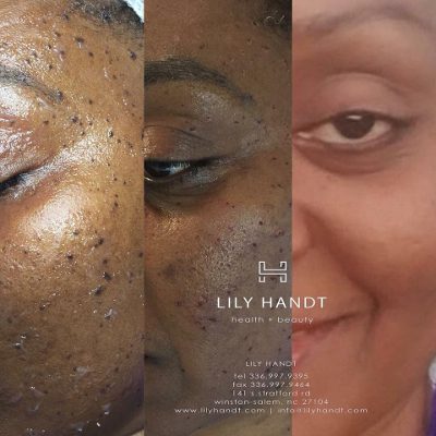 Spot Removal in Winston-Salem, North Carolina