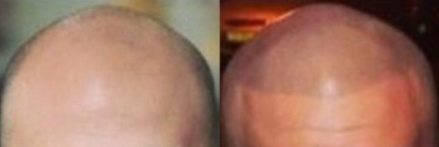 Scalp Micropigmentation in Winston-Salem, North Carolina