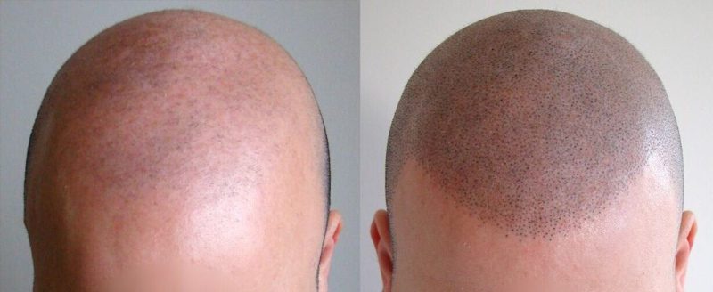 Scalp Micropigmentation in Winston-Salem, North Carolina