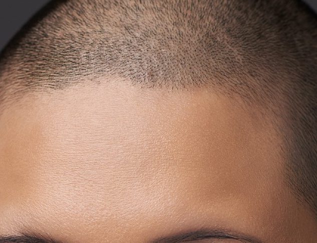 Scalp Micropigmentation in Winston-Salem, North Carolina