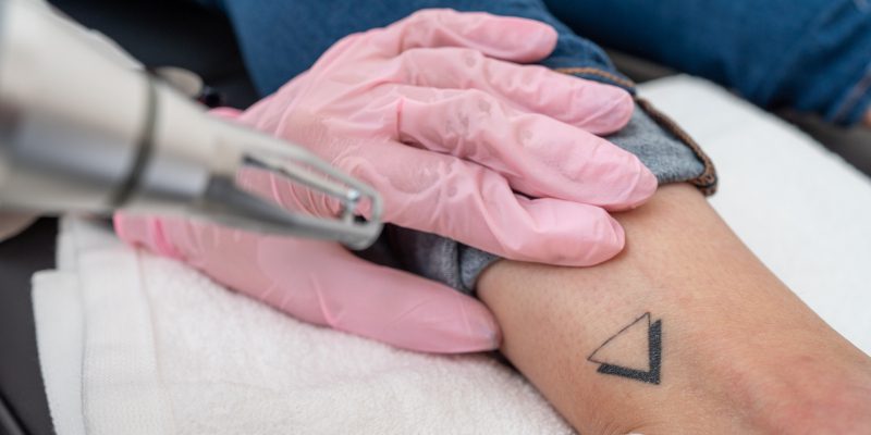 Tattoo Removal in Asheboro, North Carolina