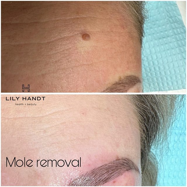 mole removal services