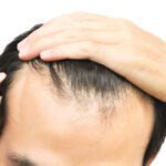 Hair Restoration