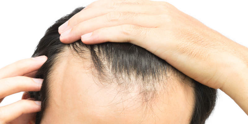 Hair Restoration in Winston-Salem, North Carolina